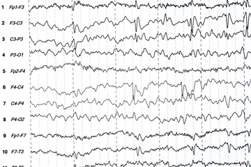 Brain wave patterns on electroencephalogram, EEG of the pediatric patients, problems in the...