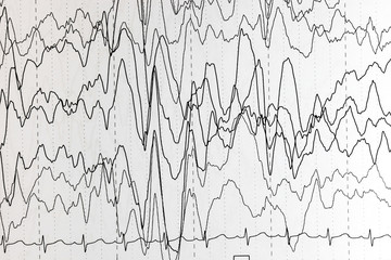 Brain wave patterns on electroencephalogram, EEG of the pediatric patients, problems in the...