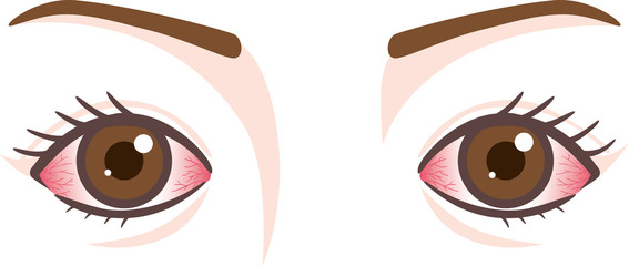 目の症状　充血　結膜炎