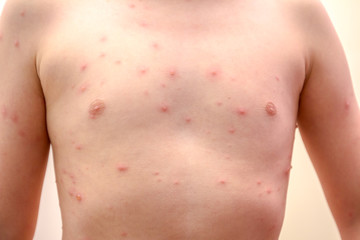 Child skin infected with chickenpox