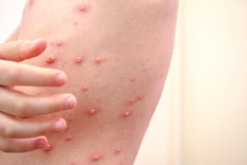 Child skin infected with chickenpox