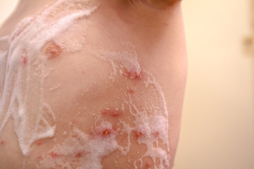 Fototapeta premium Therapy against the virus of Varicella has measles, chicken pox, rubella