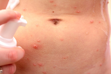Therapy against the virus of Varicella has measles, chicken pox, rubella