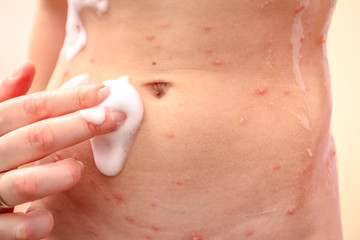Therapy against the virus of Varicella has measles, chicken pox, rubella