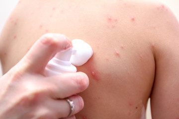 Fototapeta premium Therapy against the virus of Varicella has measles, chicken pox, rubella