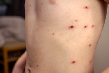 Child skin infected with chickenpox - obrazy, fototapety, plakaty