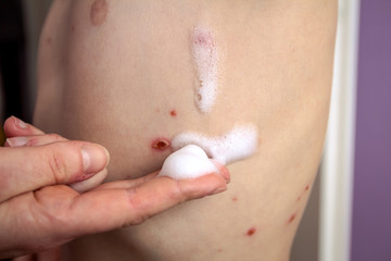 Naklejka premium Therapy against the virus of Varicella has measles, chicken pox, rubella