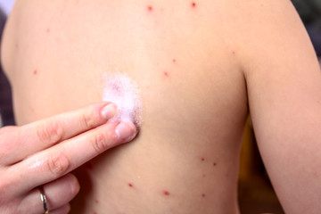 Fototapeta premium Therapy against the virus of Varicella has measles, chicken pox, rubella