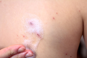 Fototapeta premium Therapy against the virus of Varicella has measles, chicken pox, rubella