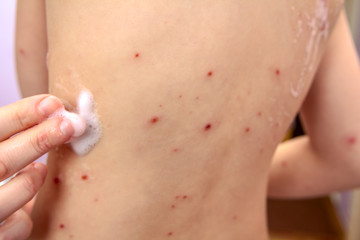 Therapy against the virus of Varicella has measles, chicken pox, rubella