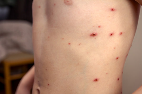 Child skin infected with chickenpox