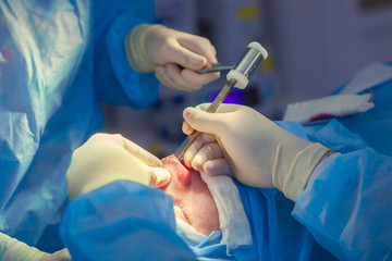 Surgeon and his assistant performing cosmetic surgery on nose in hospital operating room. Nose reshaping, augmentation. Rhinoplasty. Hammer.