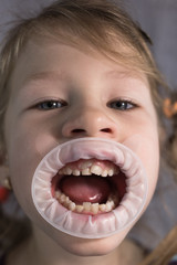 Adult permanent teeth coming in front of the child's baby teeth: shark teeth.