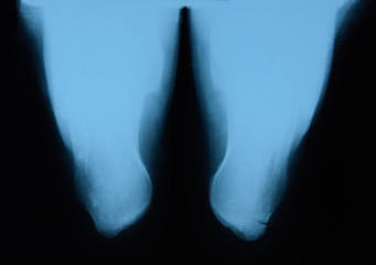 Obraz premium X-ray of feet and heel bones. X ray picture of bones.