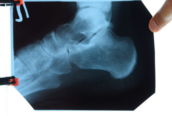 X-ray of feet and heel bones. X ray picture of bones.