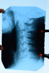 X-ray of the cervical vertebrae. X ray image of the cervical spine.