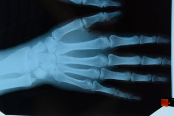 X ray of the hands, a picture of the bones of the hands on the x-ray.