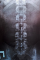 X ray of the lumbar spine, spine on x-ray