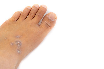 Dermatitis, ill allergic rash dermatitis or eczema skin on the legs over white background