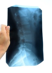 X ray of the lumbar spine, spine on x-ray