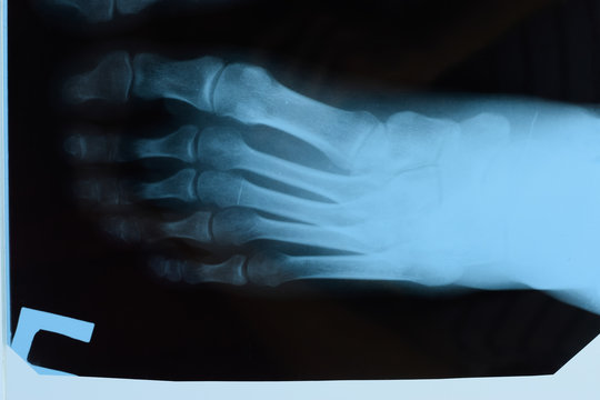 X-ray of toes. Foot on Xray. bone research
