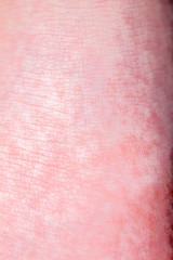 Scarlet Fever starts with a red rush and the strawberry tongue Afterwards the affected skin often peels - Here red skin rush
