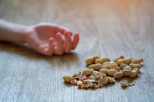 Person has lost consciousness from allergic reaction to peanuts. Danger of food allergies. Nuts allergy