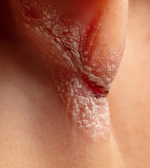 Inflamed wound in the boy's ear