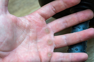 Hand with corn, callus, callosity, induration, congelation on the palm because of physical activity sports