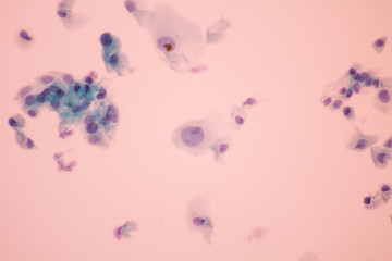 View in microscopic of abnormal human cervix cells.Squamous epithelium cells.Superficial and...