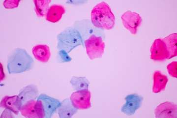 View in microscopic of abnormal human cervix cells.Squamous epithelium cells.Superficial and...