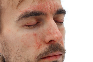 head of sick man with closed eyes with red allergic reaction on facial skin, redness and peeling...