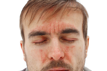 Fototapeta premium head of sick man with closed eyes with red allergic reaction on facial skin, redness and peeling psoriasis on nose, forehead and cheeks, seasonal skin problem, white background