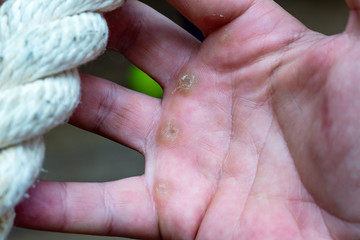 Hand with rope corn, callus, callosity, induration, congelation on the palm because of physical activity sports gym sport concept