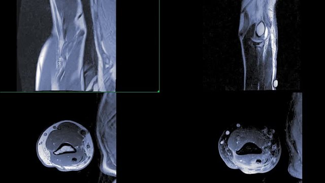 MRI Elbow or Magnetic resonance imaging of elbow.