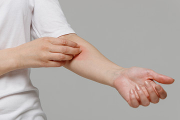 Close up of woman scratching the itch on her hand, isolated on grey background. Dry skin,...