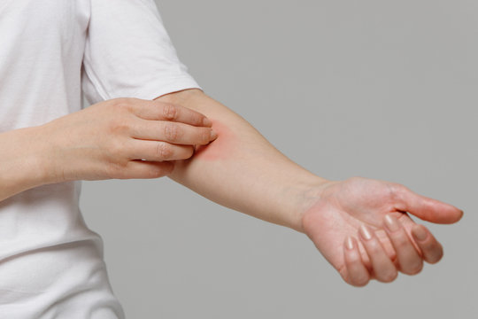 Close up of woman scratching the itch on her hand, isolated on grey background. Dry skin, animal/food allergy, dermatitis, insect bites, irritation concept. 
