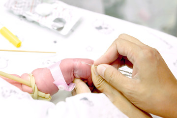 Image of nurse hands uses gradually stabbing IV Catheter (small medical needle for insert injection plug) at sick baby's hands to prepare fill the saline solution and medicine.