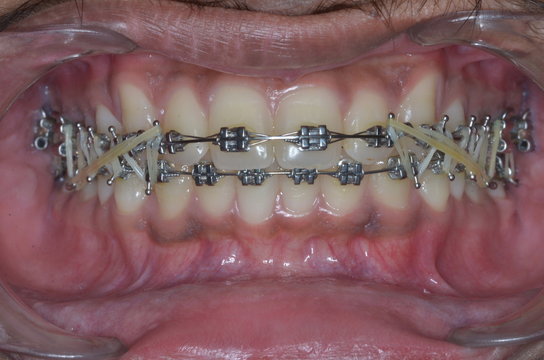 braces treatment for male teeth