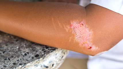 The wound on the arm of a young skin dry are be healed.