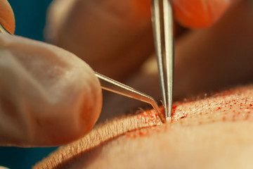 Macrophotography of a hair bulb transplanted into a hairless area. Baldness treatment. Hair...