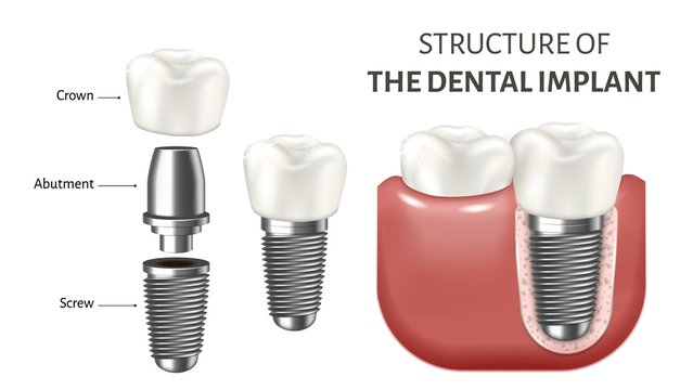 Medical vector illustration showing a structure of the dental implant. Realistic image isolated on the white background.