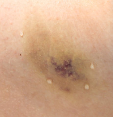 Bruise on the skin as a background