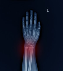 Left Wrist X-ray fracture raduis on red mark.