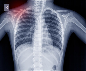 Chest x-ray fracture right clavicle.