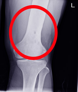 Knee joint.No fracture, dislocation , bony destruction .
