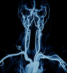 Magnetic Resonance Angiogram of the brain vasculature (arteries)