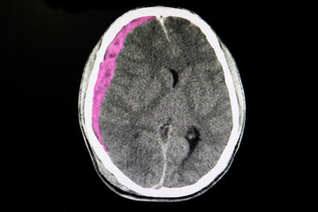 CT brain scan with acute subdural hematoma