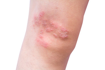 Close-up eczema atopic dermatitis symptom with infected skin on child leg, kid knee with copy...
