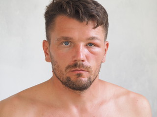 Obraz premium Portrait of a man stung by a wasp in the forehead. Tumor after a bite on the face.